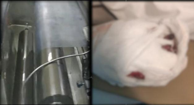 学生称被强制要求到工厂实习：手被卷入机器致残 学校让自行协商